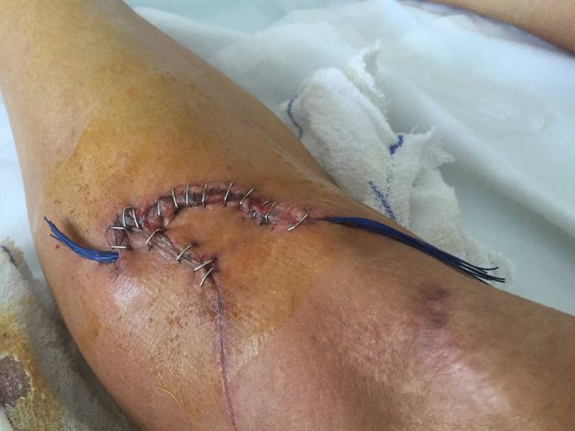 Il ginocchio di Francisco Ventoso con i punti dopo l&#39;incidente. Facebook